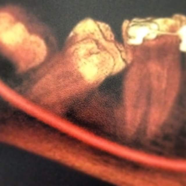 Cirurgias orais menores