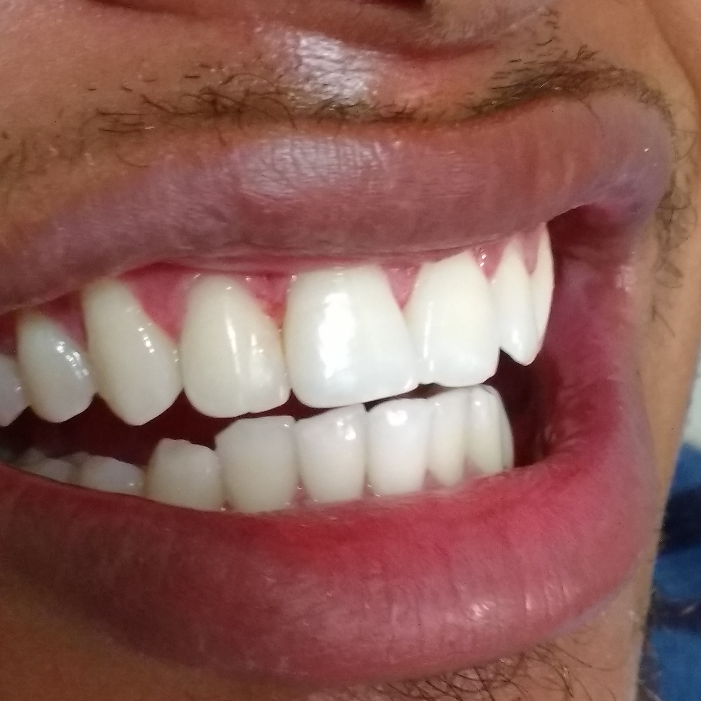 Clareamento Dental